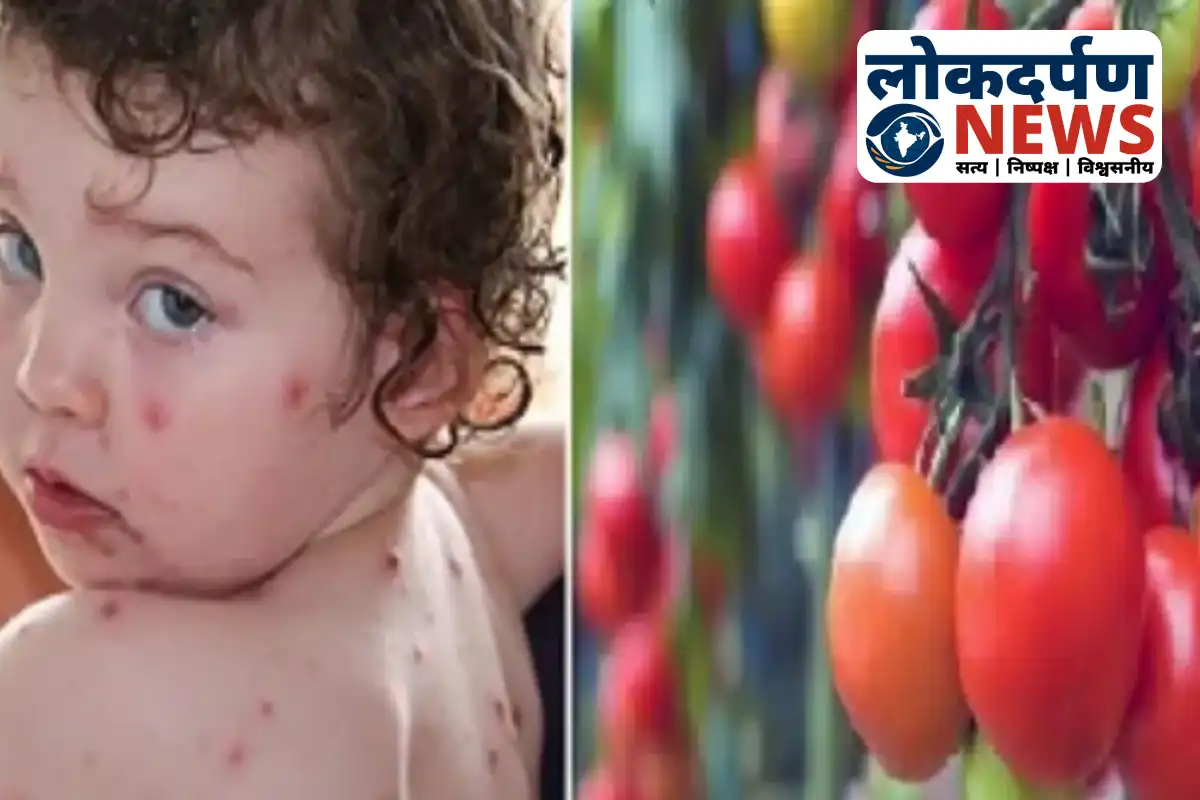 Children affected by tomato flu in Gorakhpur