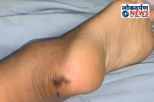 Gorakhpur गोरखपुर में सांप के काटने से अधेड़ की मौत, परिवार में शोक की लहर