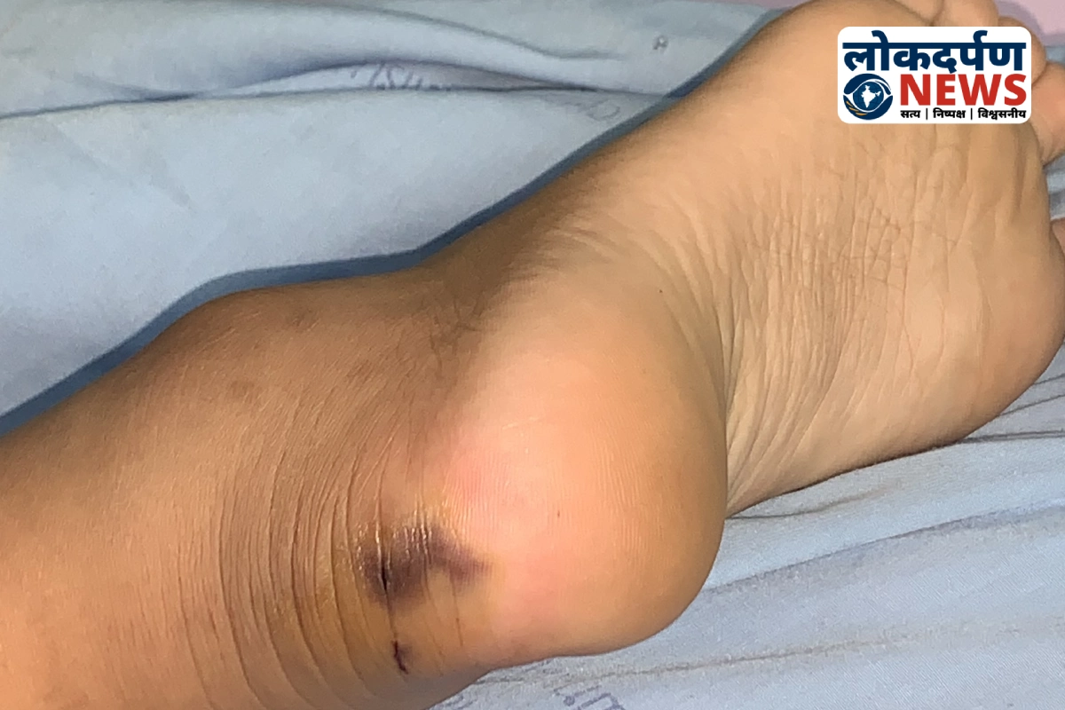 Snake bite incident in Katasahara village, Gorakhpur | Gorakhpur News